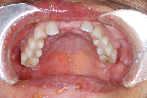 に 口 水疱 中 の 口の中に出来る水ぶくれ3つの原因と対処方法