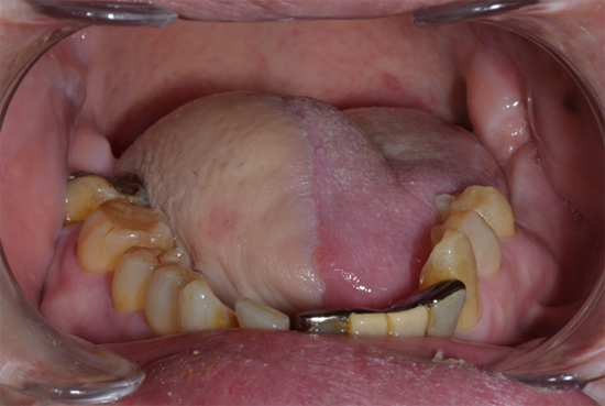 舌がん（舌半側切除、遊離前腕皮弁移植後）