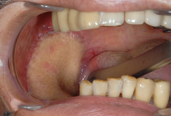 下顎歯肉がん（下顎区域切除、遊離肩甲骨複合皮弁移植後）